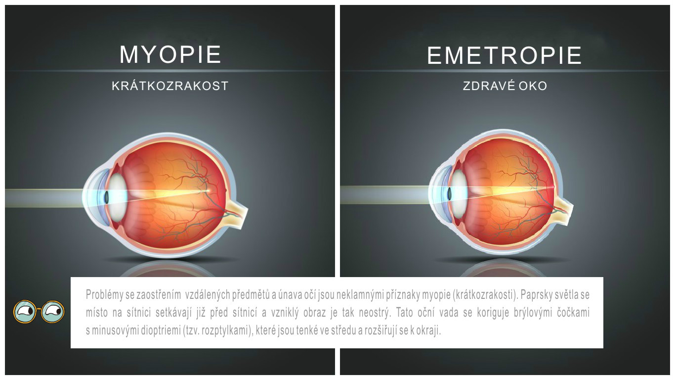 myopia problémák